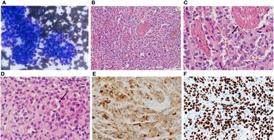 Case report: Dramatic response to pralsetinib in an elderly patient with advanced RET-fusion positive papillary thyroid carcinoma